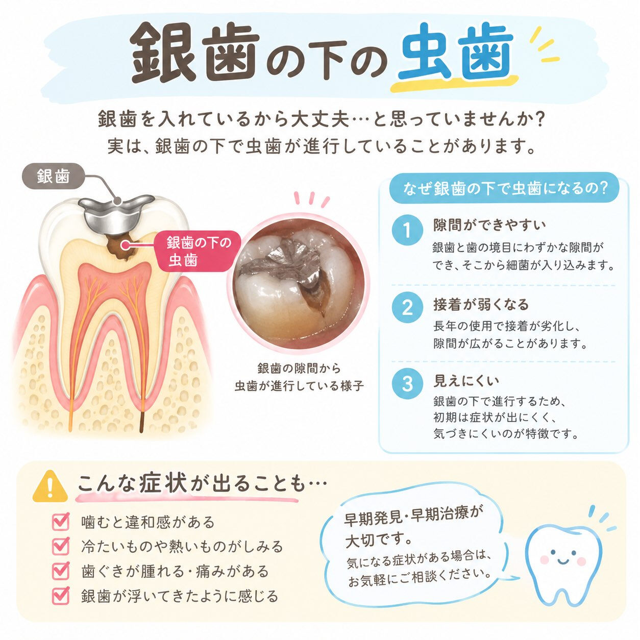 🦷【銀歯の下にも虫歯ができる？】