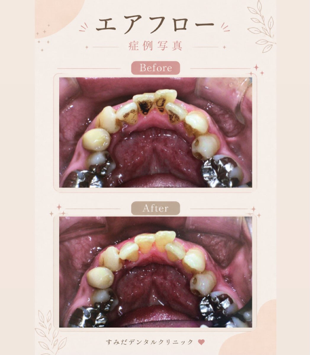 🦷✨ エアフロー症例のご紹介